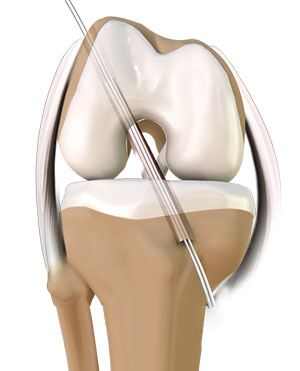 Anterior Cruciate Ligament ACL Reconstruction