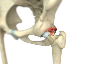 Femoral Acetabular Impingement