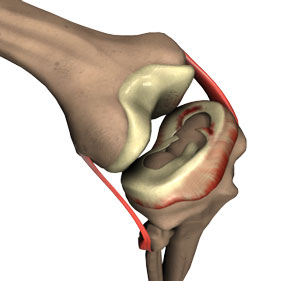 Meniscal Tear