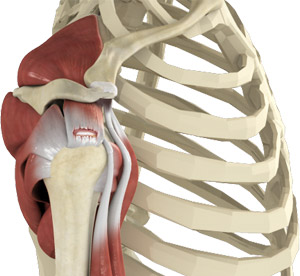 Rotator Cuff Tear